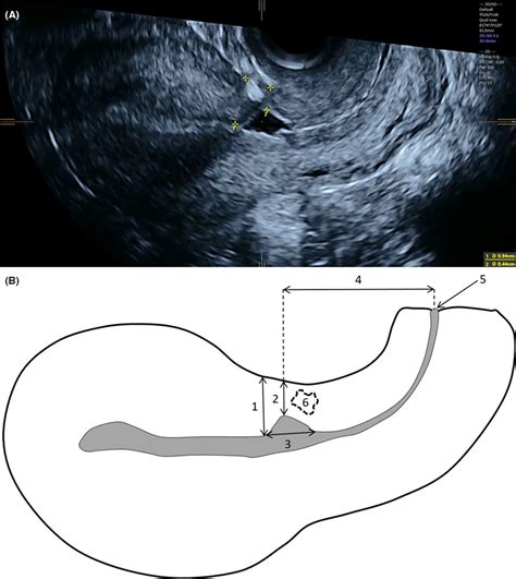 ultrasound measurement of cesarean scar thickness|cesarean section scar identification.